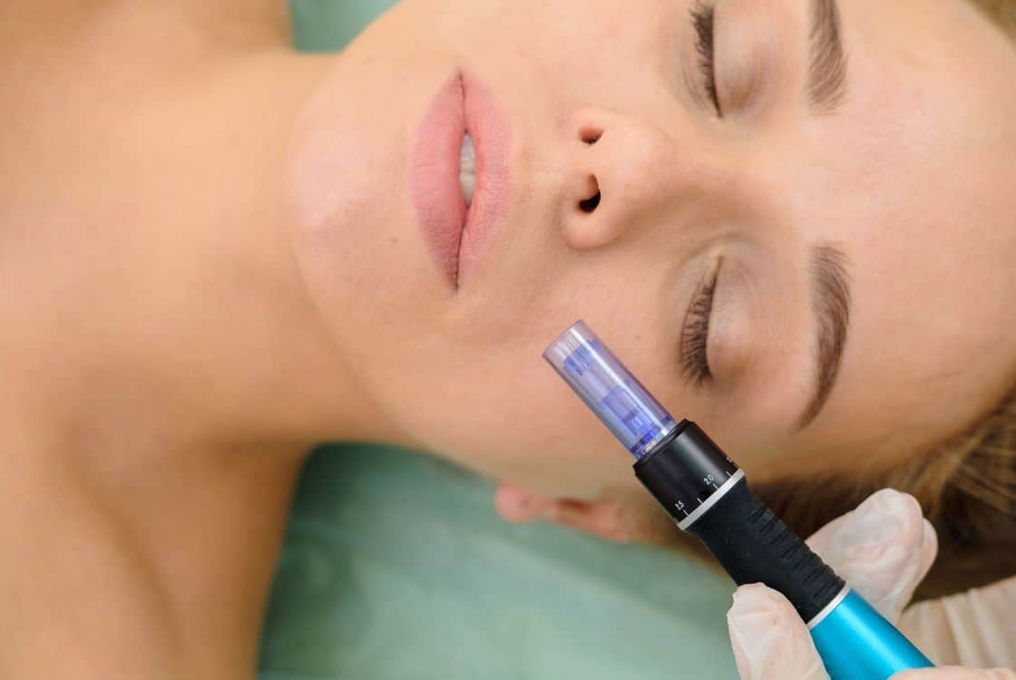 ¿Cómo El Microneedling Rejuvenece La Cara Sin Cirugía?