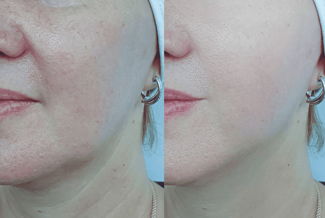 resultados esperados de la microdermoabrasión