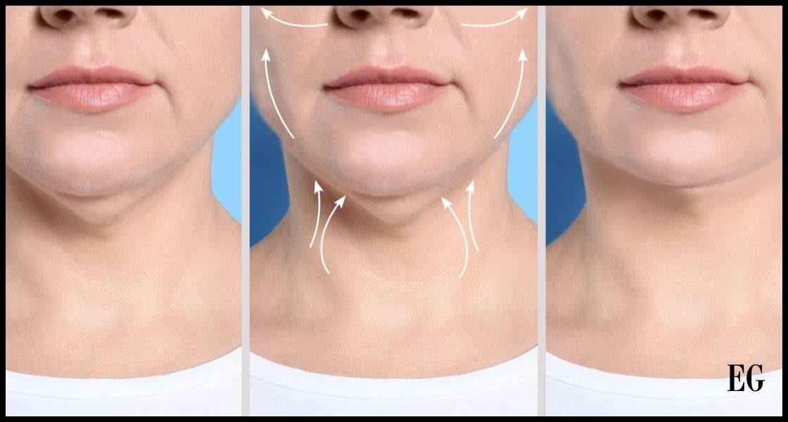 "Imagen de antes y después de un tratamiento de radiofrecuencia facial, mostrando el perfil de una mujer con la piel del cuello y el contorno del rostro antes del tratamiento, durante el proceso con flechas indicativas de la dirección del efecto tensor, y después del tratamiento con la piel visiblemente más tersa y contorneada."