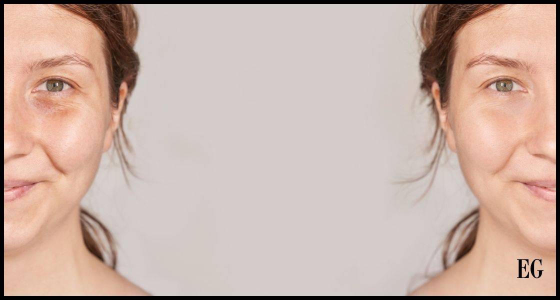 El rostro de una persona antes y después de un tratamiento facial con radiofrecuencia